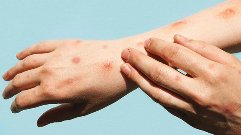 CANAVESE - Vaiolo delle scimmie, ecco le nuove indicazioni della Regione su vaccinazioni e misure di protezione