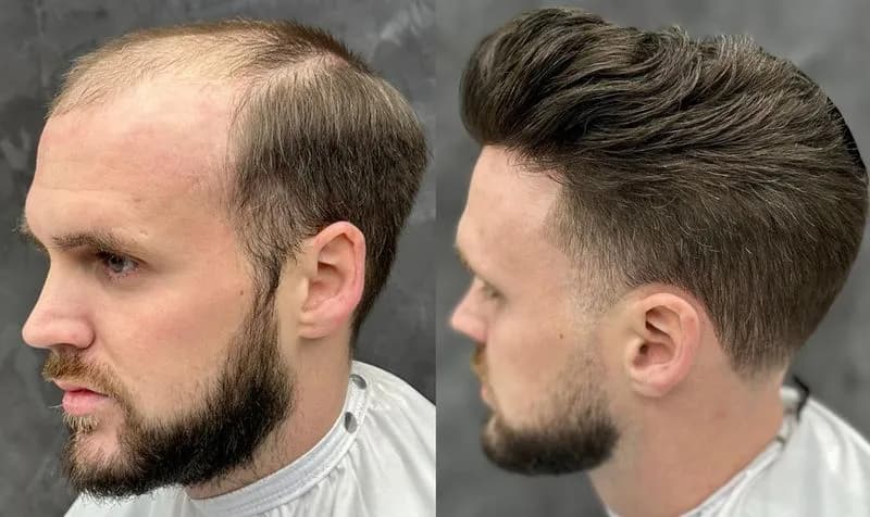 GLAMOUR - Hair system, la rivincita del parrucchino