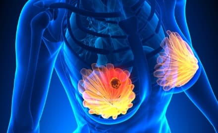 CANAVESE - Tumore al seno: aumentano gli esami di prevenzione